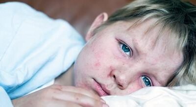 Measles Outbreak: Causes, Impact, and Prevention