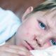 Measles Outbreak: Causes, Impact, and Prevention