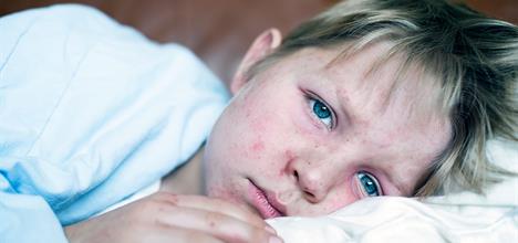 Measles Outbreak: Causes, Impact, and Prevention