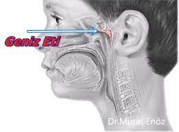 Adenoidid: Symptoms, Causes, Diagnosis, and Treatment