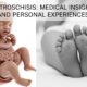 Gastroschisis: Medical Insights and Personal Experiences